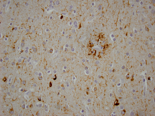 Neurofibrillary Tangle